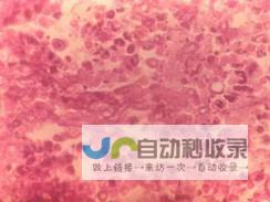 败血症